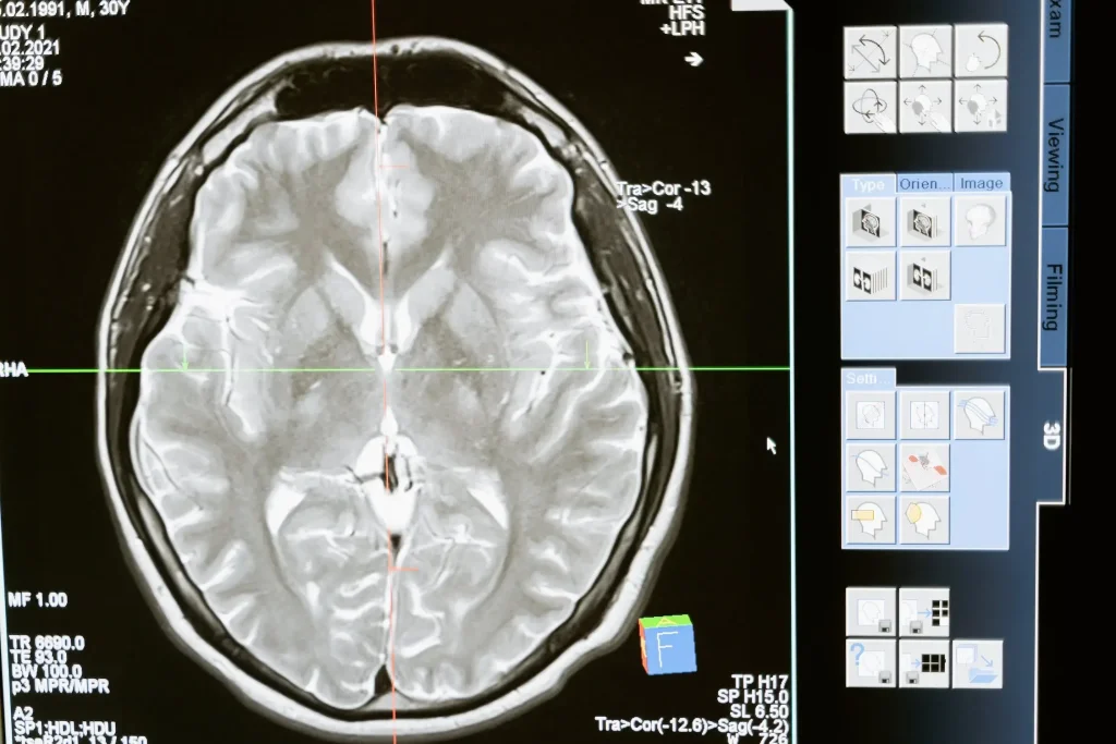 Facing a Brain Injury in New York? Our Legal Team is Your Stronghold of Support